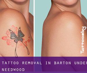 Tattoo Removal in Barton under Needwood
