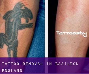 Tattoo Removal in Basildon (England)