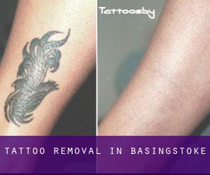 Tattoo Removal in Basingstoke