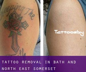 Tattoo Removal in Bath and North East Somerset