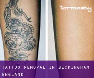 Tattoo Removal in Beckingham (England)