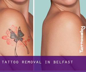 Tattoo Removal in Belfast
