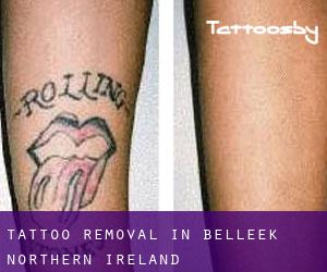 Tattoo Removal in Belleek (Northern Ireland)