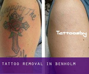 Tattoo Removal in Benholm