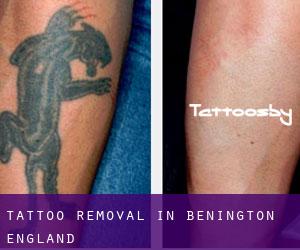 Tattoo Removal in Benington (England)