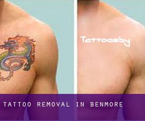 Tattoo Removal in Benmore