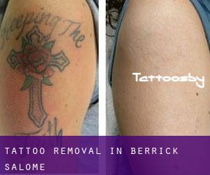 Tattoo Removal in Berrick Salome