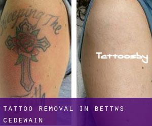 Tattoo Removal in Bettws Cedewain