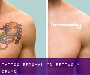 Tattoo Removal in Bettws y Crwyn