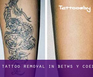 Tattoo Removal in Betws-y-Coed
