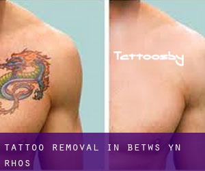 Tattoo Removal in Betws-yn-Rhôs