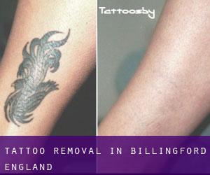 Tattoo Removal in Billingford (England)