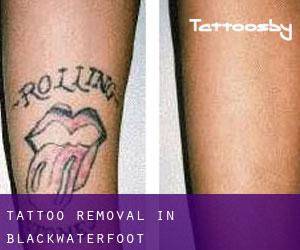 Tattoo Removal in Blackwaterfoot