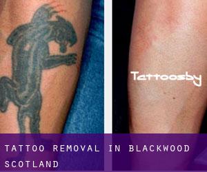 Tattoo Removal in Blackwood (Scotland)