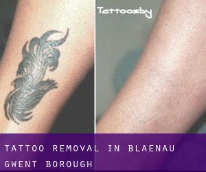 Tattoo Removal in Blaenau Gwent (Borough)