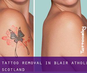 Tattoo Removal in Blair Atholl (Scotland)