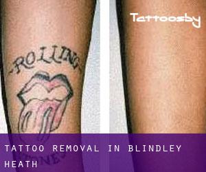 Tattoo Removal in Blindley Heath