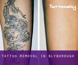 Tattoo Removal in Blyborough