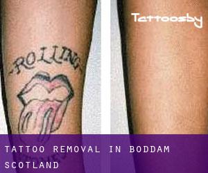 Tattoo Removal in Boddam (Scotland)
