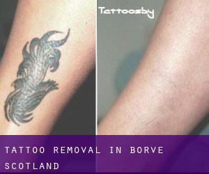 Tattoo Removal in Borve (Scotland)