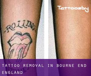 Tattoo Removal in Bourne End (England)