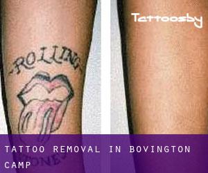 Tattoo Removal in Bovington Camp