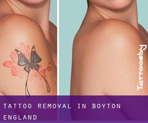 Tattoo Removal in Boyton (England)