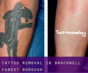 Tattoo Removal in Bracknell Forest (Borough)