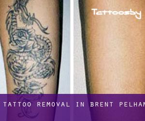 Tattoo Removal in Brent Pelham