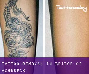 Tattoo Removal in Bridge of Achbreck