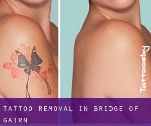 Tattoo Removal in Bridge of Gairn