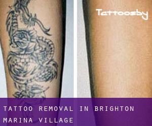Tattoo Removal in Brighton Marina village