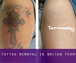 Tattoo Removal in Briton Ferry