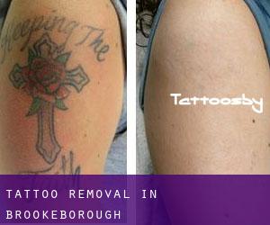 Tattoo Removal in Brookeborough