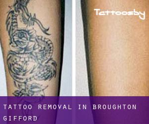 Tattoo Removal in Broughton Gifford