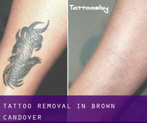 Tattoo Removal in Brown Candover