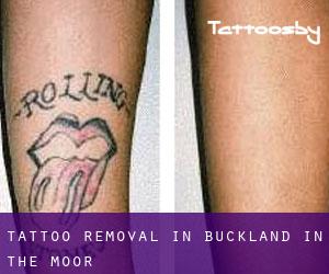 Tattoo Removal in Buckland in the Moor
