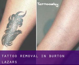 Tattoo Removal in Burton Lazars