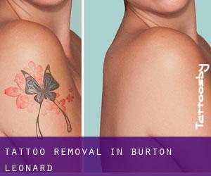 Tattoo Removal in Burton Leonard