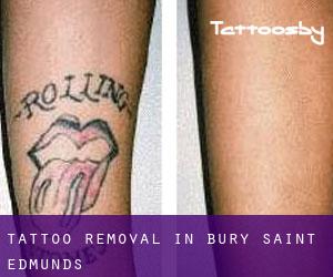 Tattoo Removal in Bury Saint Edmunds