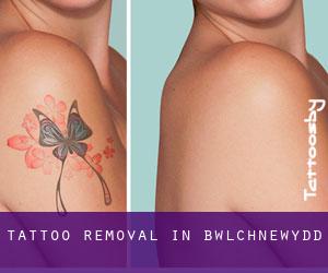 Tattoo Removal in Bwlchnewydd
