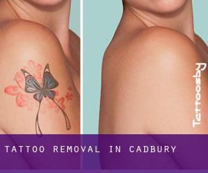 Tattoo Removal in Cadbury