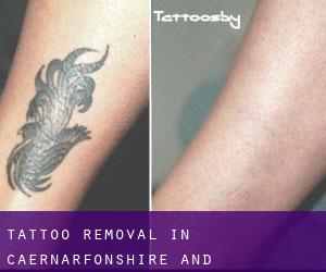 Tattoo Removal in Caernarfonshire and Merionethshire