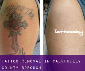 Tattoo Removal in Caerphilly (County Borough)