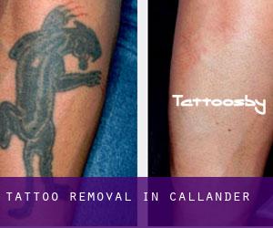 Tattoo Removal in Callander