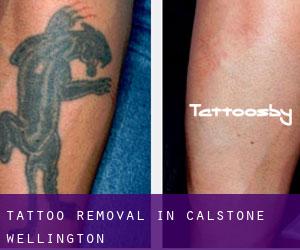 Tattoo Removal in Calstone Wellington