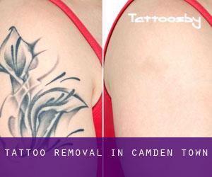 Tattoo Removal in Camden Town