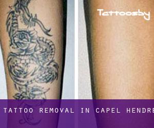 Tattoo Removal in Capel Hendre