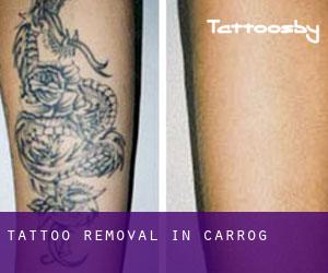 Tattoo Removal in Carrog