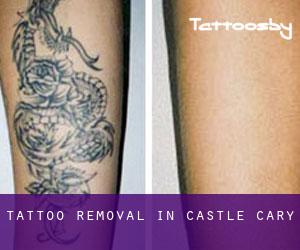 Tattoo Removal in Castle Cary